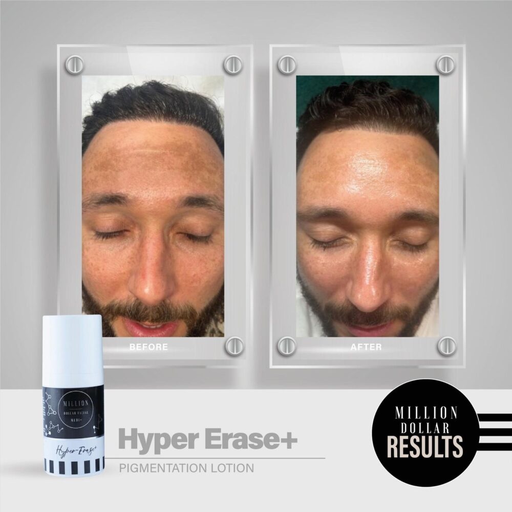 Million dollar hyper erase