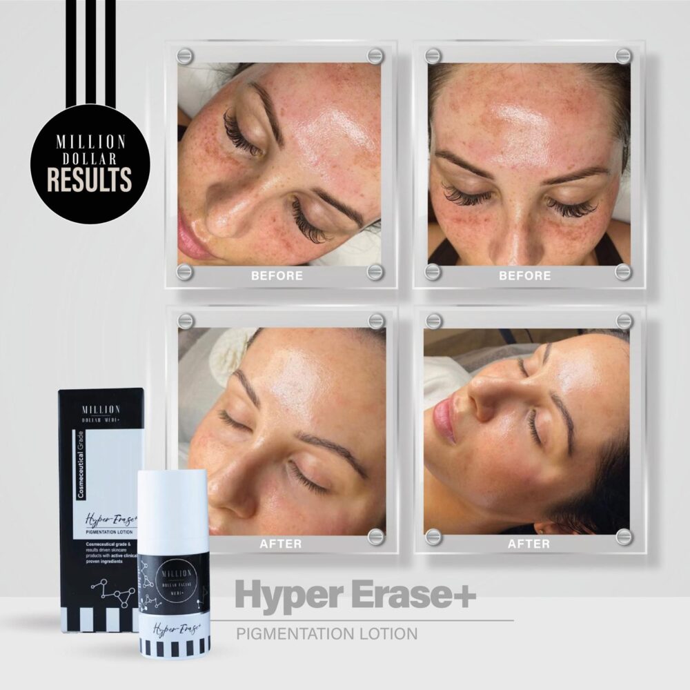 Million dollar hyper erase